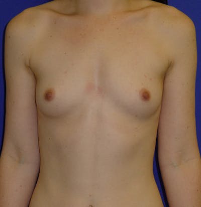 Augmentation Before & After Gallery - Patient 175183821 - Image 1