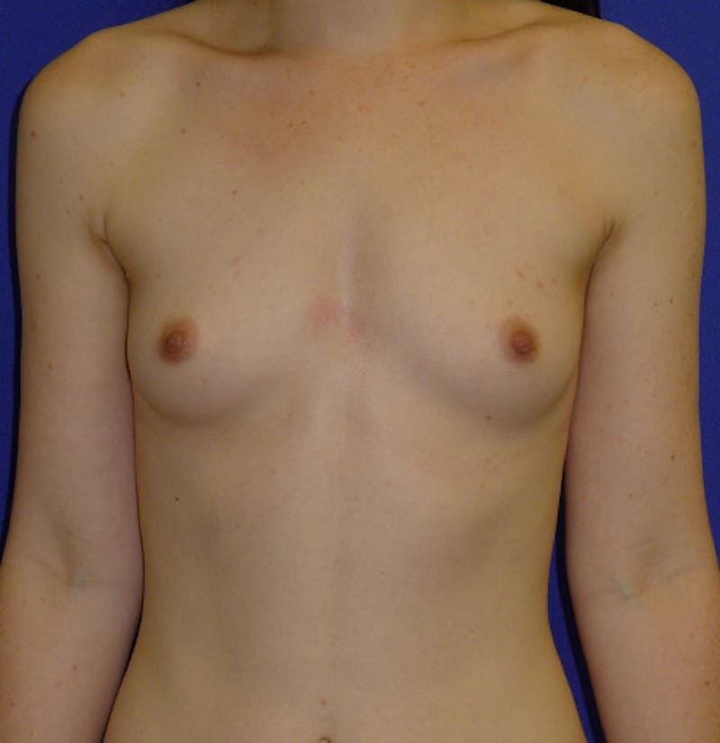 Augmentation Before & After Gallery - Patient 175183821 - Image 1