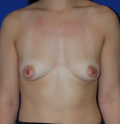 Augmentation Before & After Gallery - Patient 175183830 - Image 1