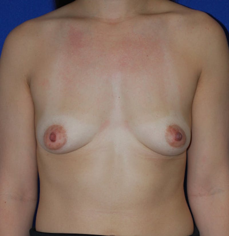 Augmentation Before & After Gallery - Patient 175183830 - Image 1