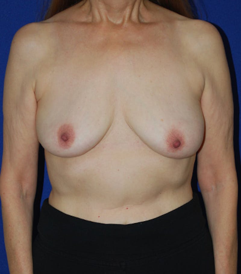 Augmentation Revision Before & After Gallery - Patient 175183836 - Image 6