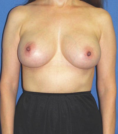 Augmentation Revision Before & After Gallery - Patient 175183836 - Image 2