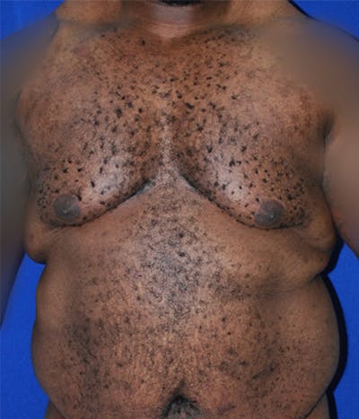 Gynecomastia Before & After Gallery - Patient 175184202 - Image 1
