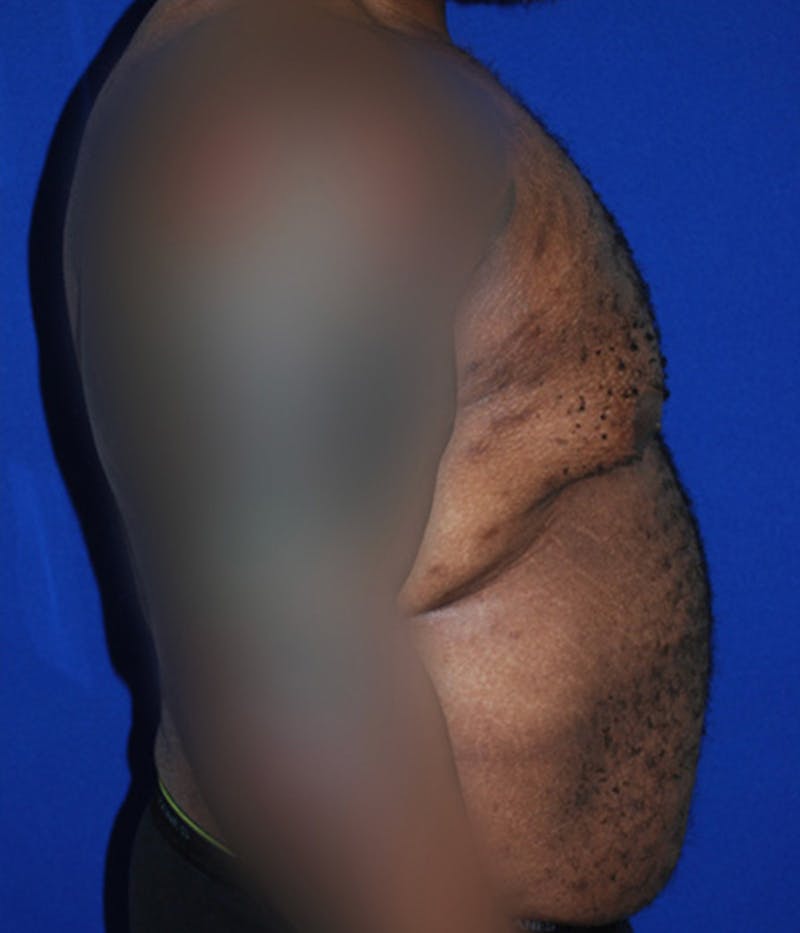 Gynecomastia Before & After Gallery - Patient 175184202 - Image 3