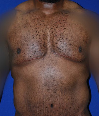 Gynecomastia Before & After Gallery - Patient 175184202 - Image 2