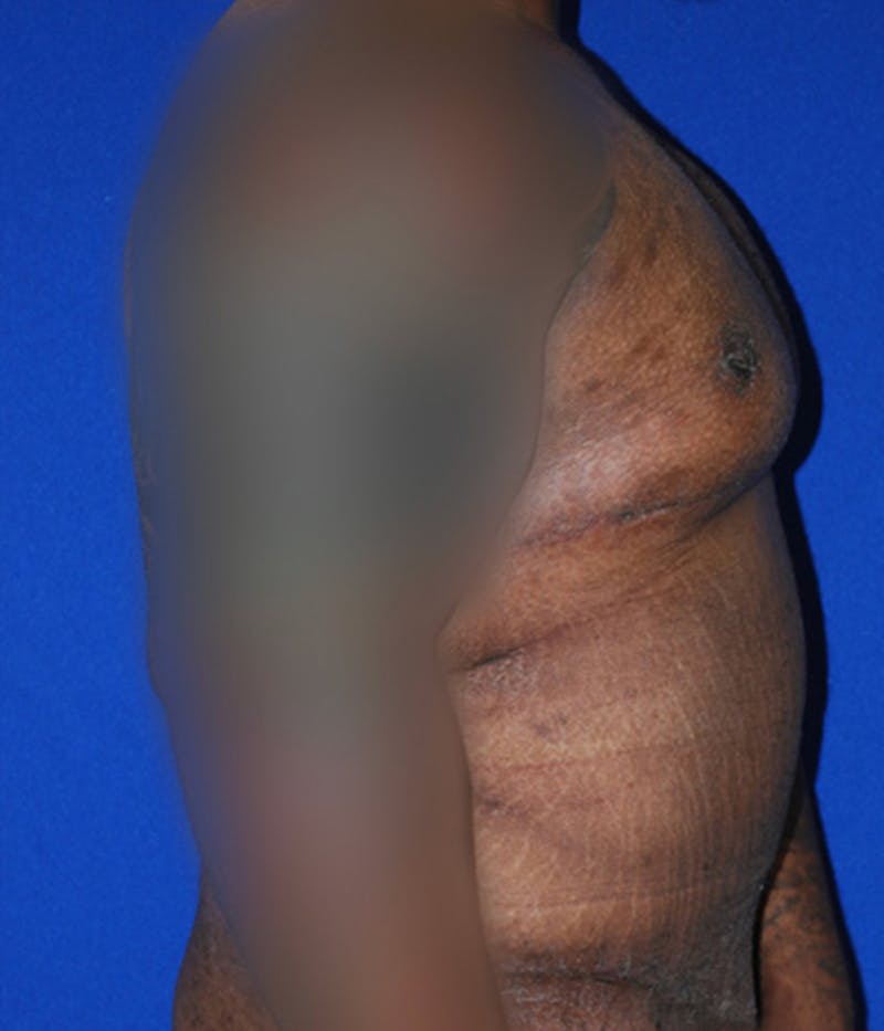 Gynecomastia Before & After Gallery - Patient 175184202 - Image 4