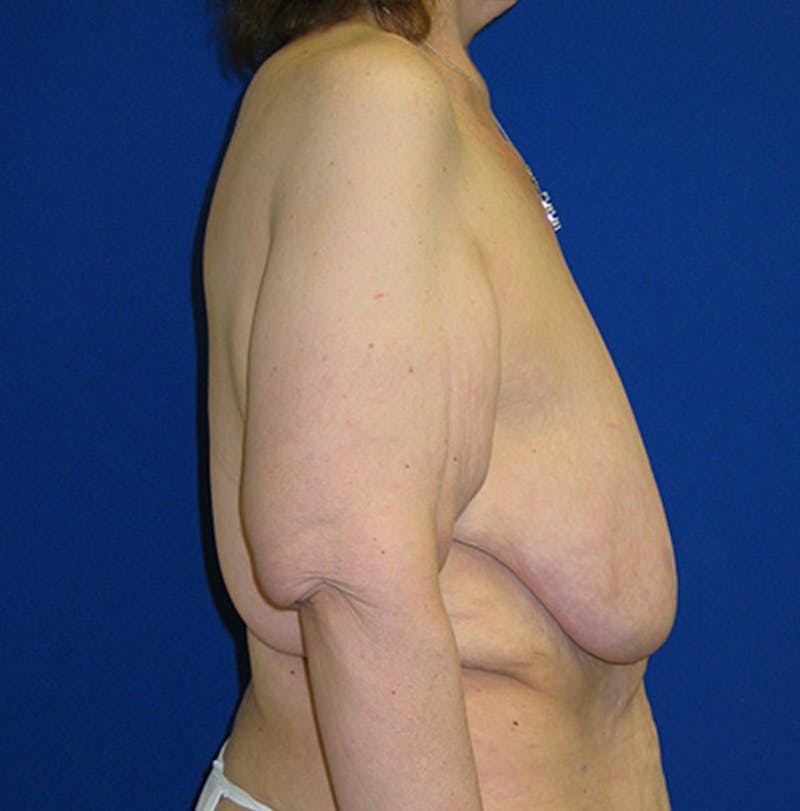 Mastopexy/Lift Before & After Gallery - Patient 175185750 - Image 3