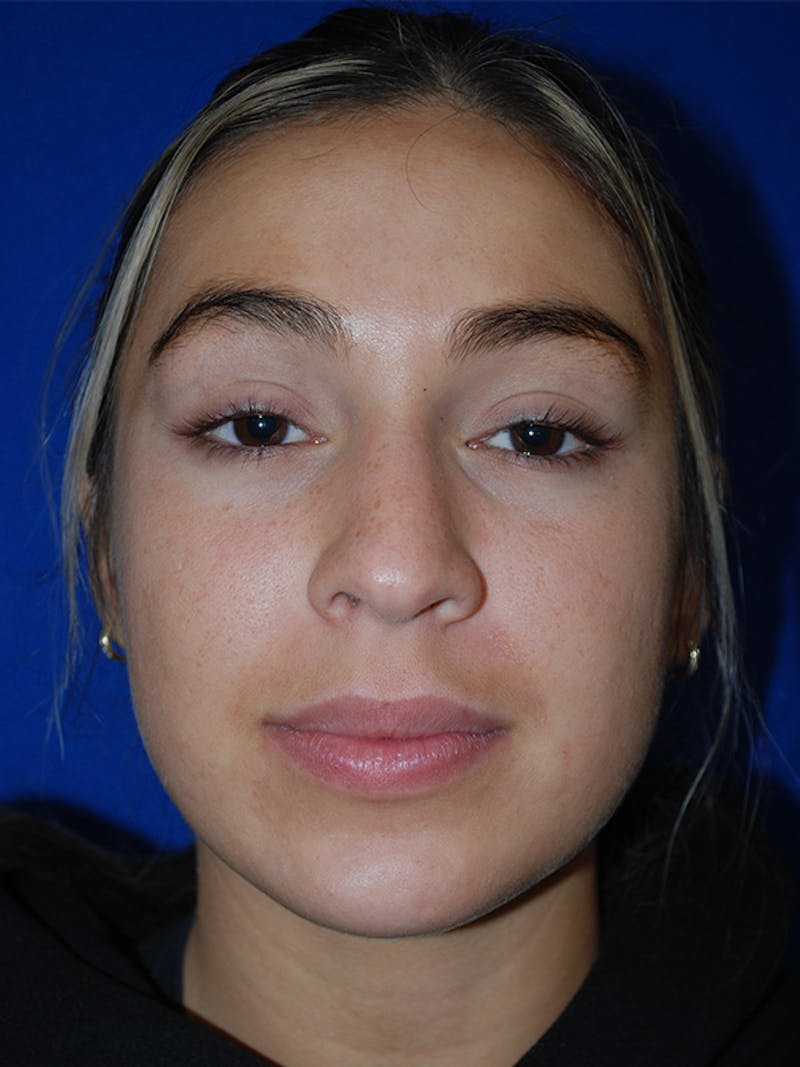 Rhinoplasty Before & After Gallery - Patient 175184795 - Image 5
