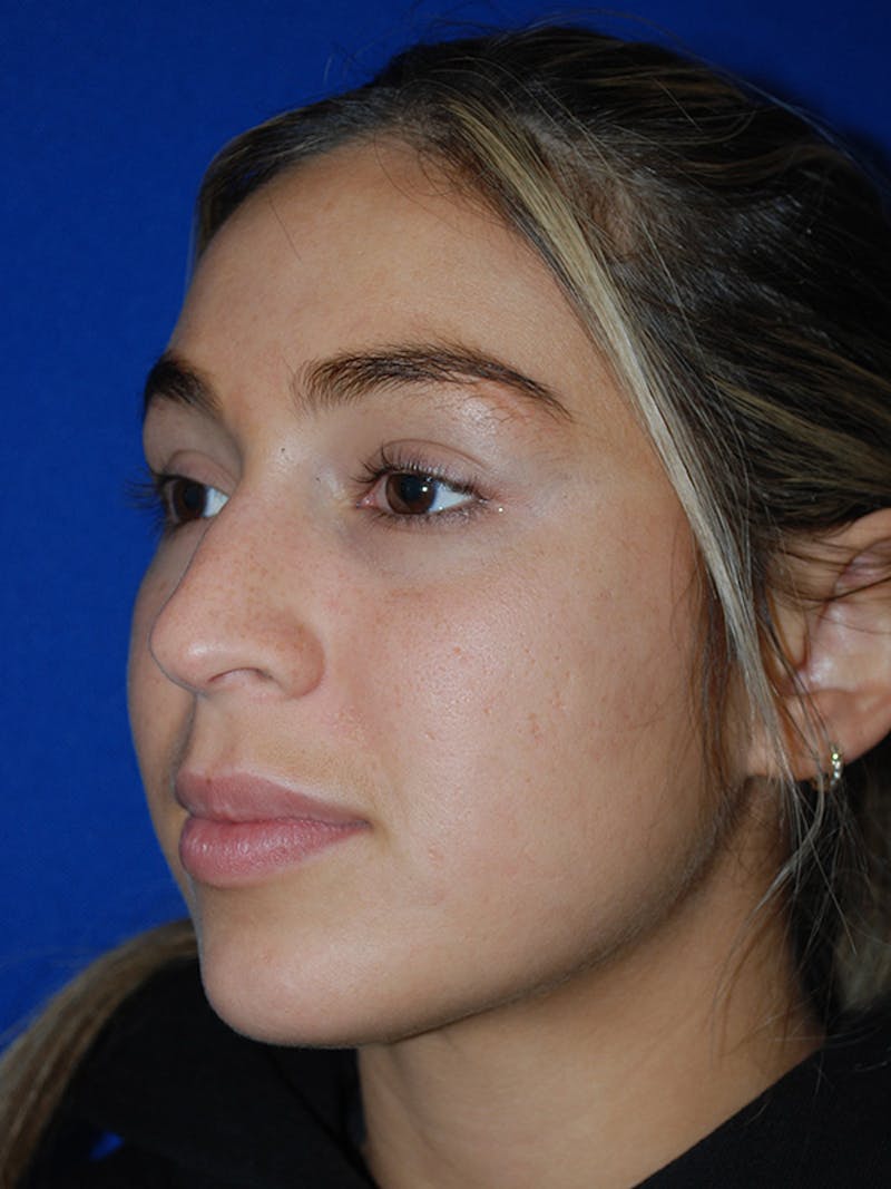 Rhinoplasty Before & After Gallery - Patient 175184795 - Image 3