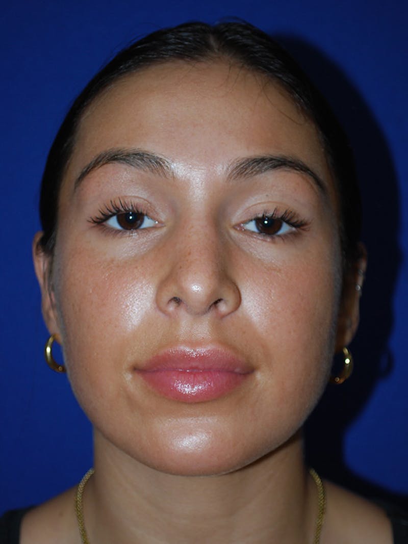 Rhinoplasty Before & After Gallery - Patient 175184795 - Image 6