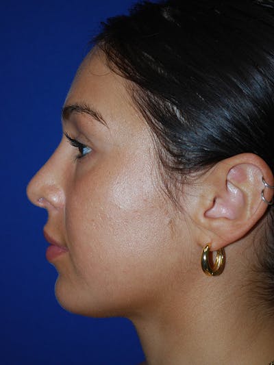 Rhinoplasty Before & After Gallery - Patient 175184795 - Image 2