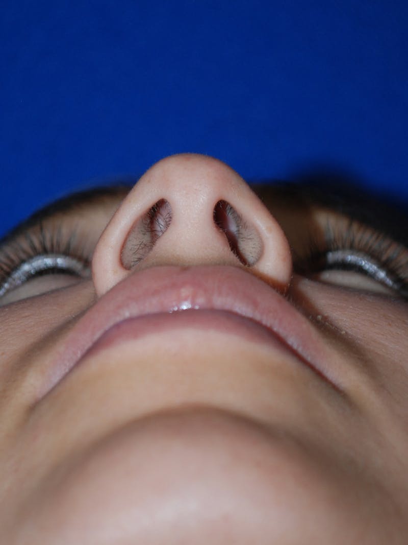 Rhinoplasty Before & After Gallery - Patient 175184795 - Image 7