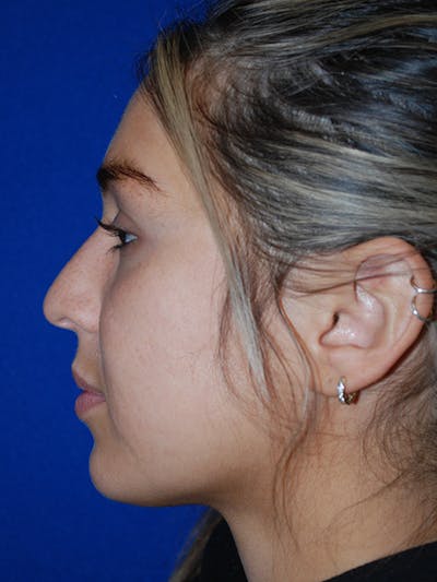 Rhinoplasty Before & After Gallery - Patient 175184795 - Image 1