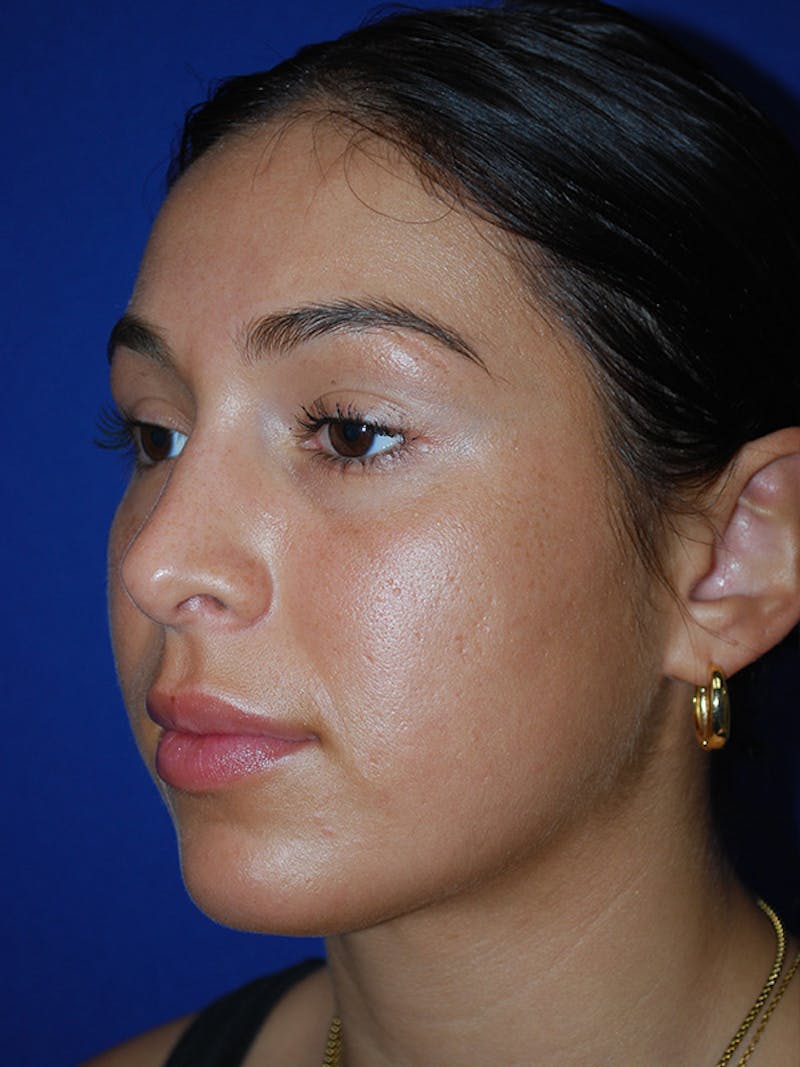 Rhinoplasty Before & After Gallery - Patient 175184795 - Image 4