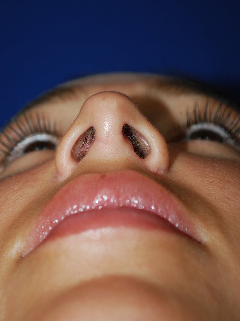 Rhinoplasty Before & After Gallery - Patient 175184795 - Image 8