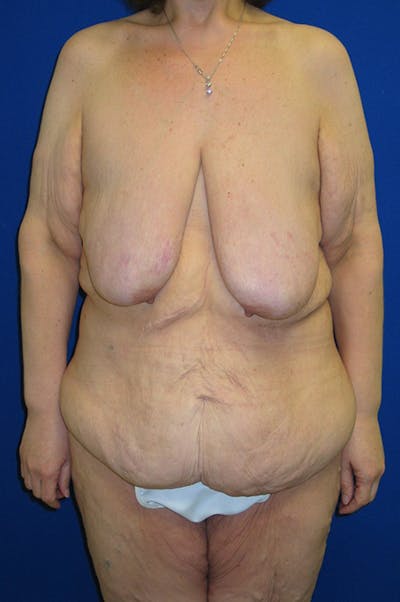 Panniculectomy Before & After Gallery - Patient 178934772 - Image 1