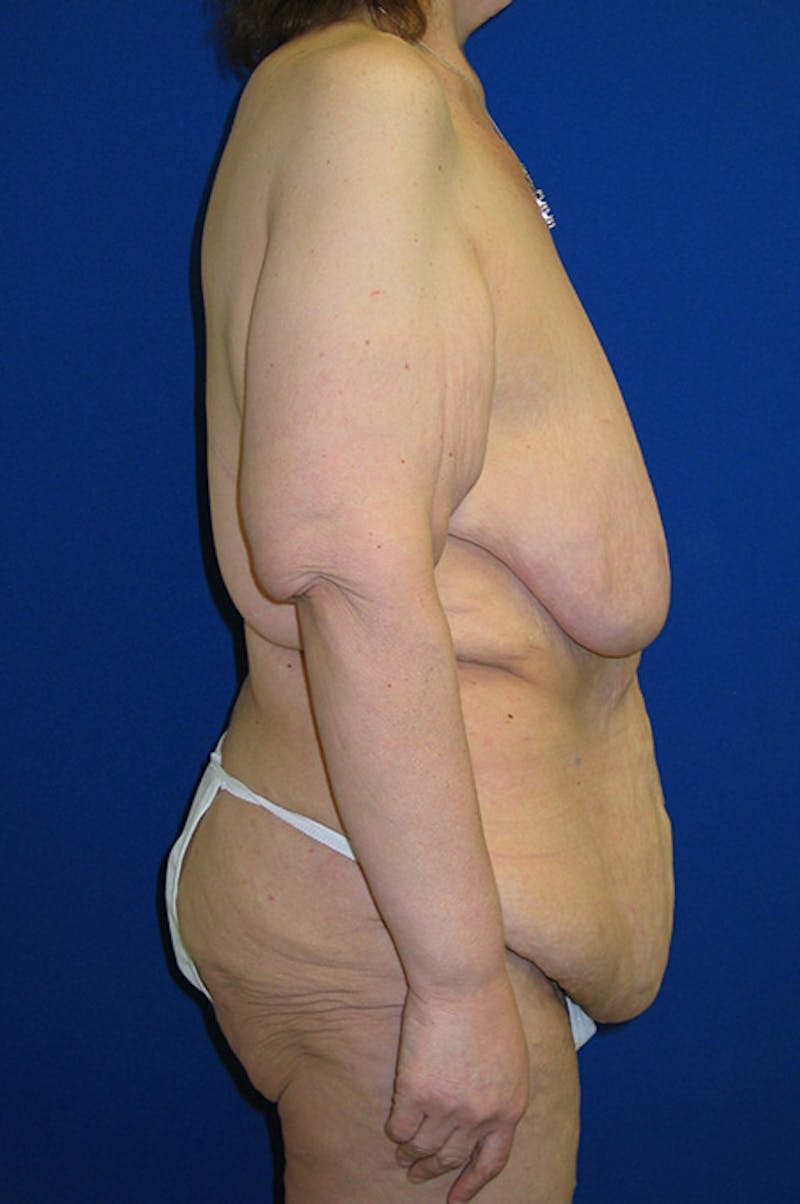 Extended Abdominoplasty Before & After Gallery - Patient 175184963 - Image 3