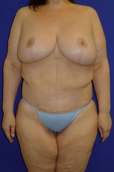 Panniculectomy Before & After Gallery - Patient 178934772 - Image 2