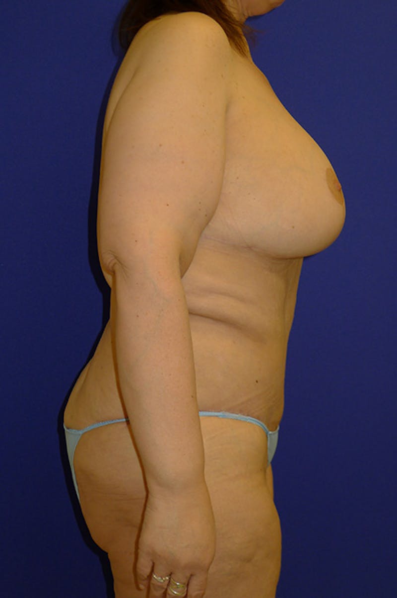 Extended Abdominoplasty Before & After Gallery - Patient 175184963 - Image 4