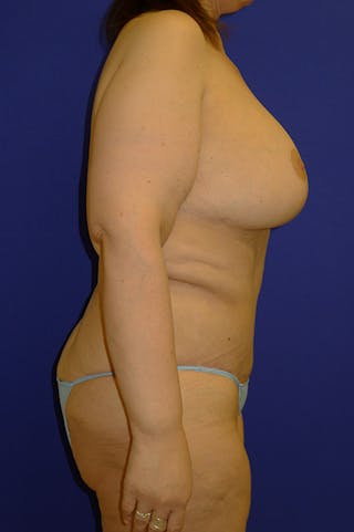 Panniculectomy Before & After Gallery - Patient 178934772 - Image 4