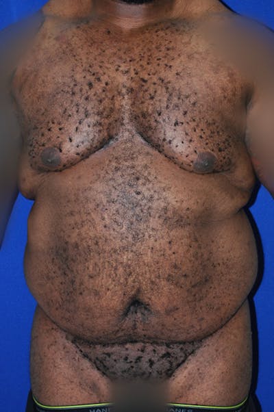 Breast Before & After Gallery - Patient 179734405 - Image 1