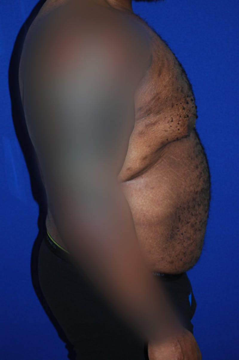 Extended Abdominoplasty Before & After Gallery - Patient 175184955 - Image 3