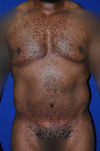 Breast Before & After Gallery - Patient 179734405 - Image 2