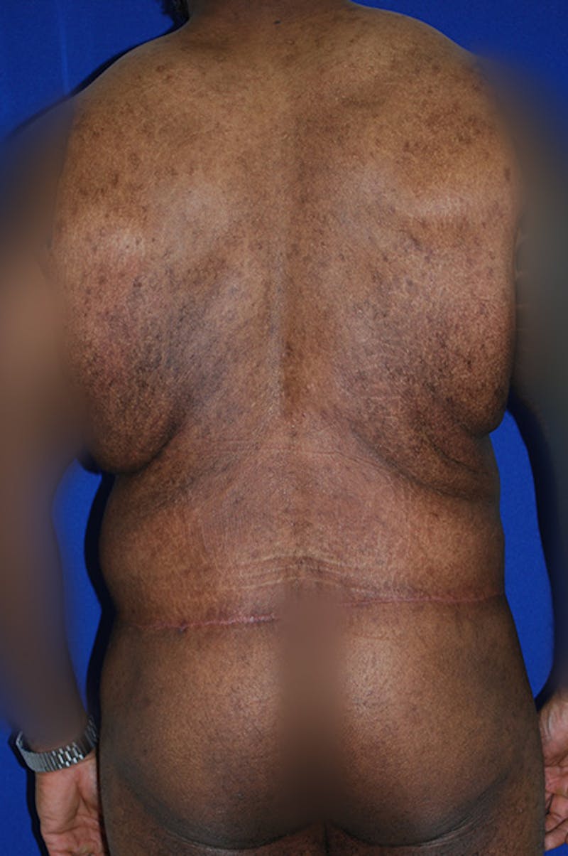 Extended Abdominoplasty Before & After Gallery - Patient 175184955 - Image 6