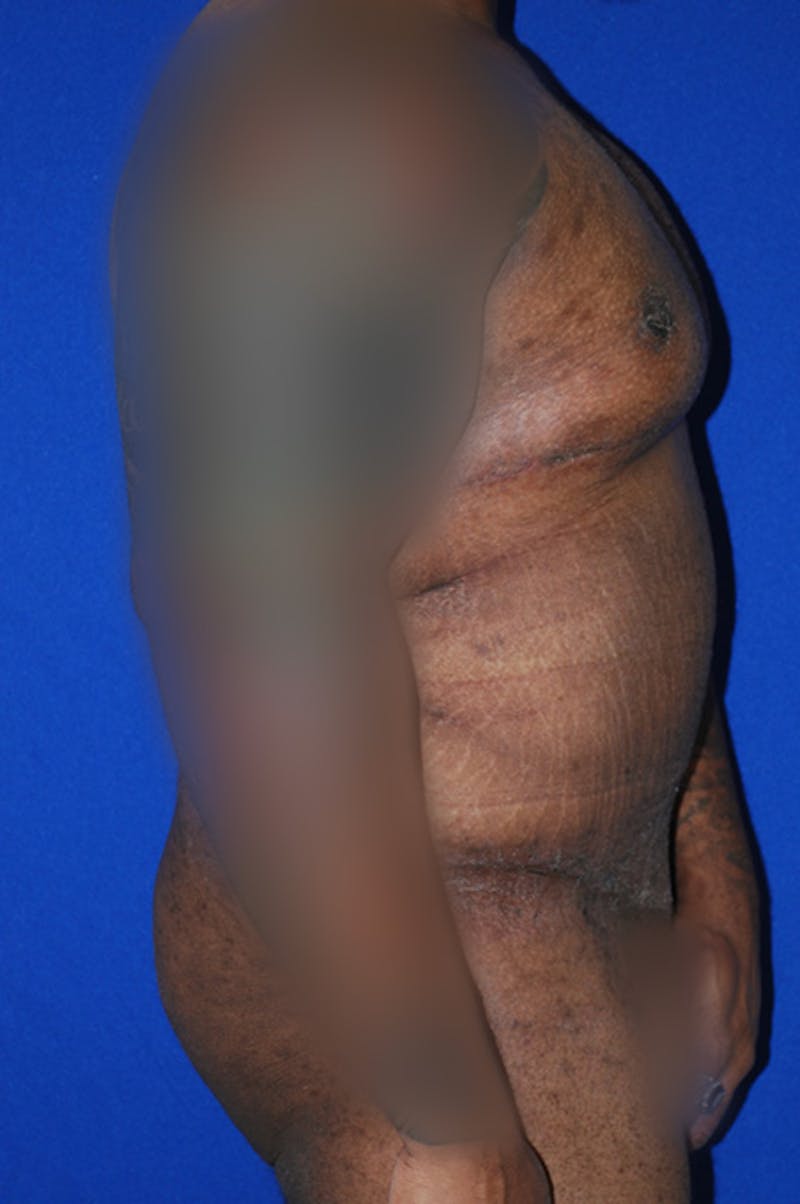 Extended Abdominoplasty Before & After Gallery - Patient 175184955 - Image 4
