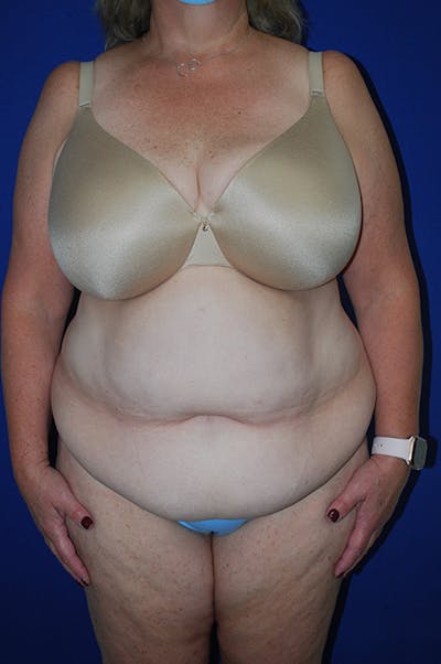 Breast Before & After Gallery - Patient 179734364 - Image 1
