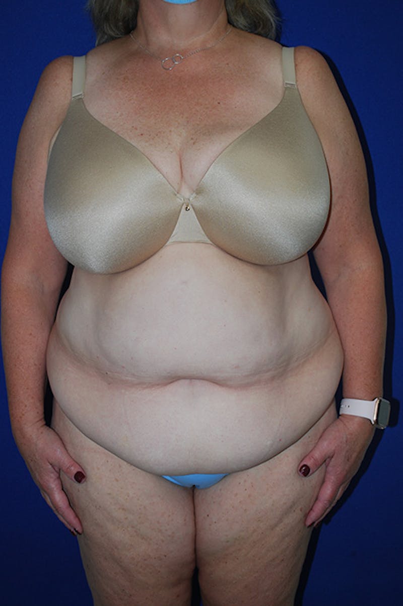Extended Abdominoplasty Before & After Gallery - Patient 175185117 - Image 1