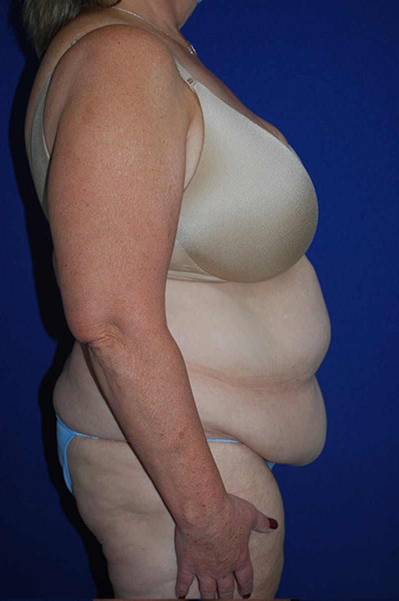 Extended Abdominoplasty Before & After Gallery - Patient 175185117 - Image 3