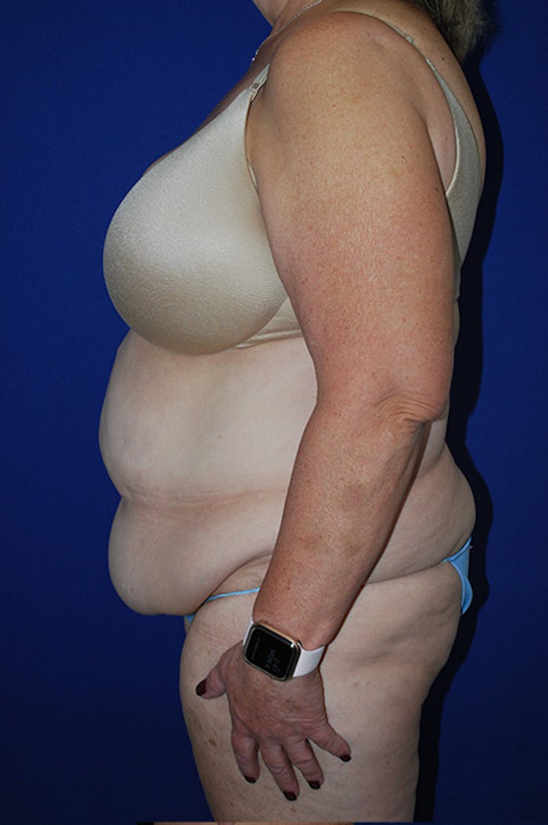 Extended Abdominoplasty Before & After Gallery - Patient 175185117 - Image 5