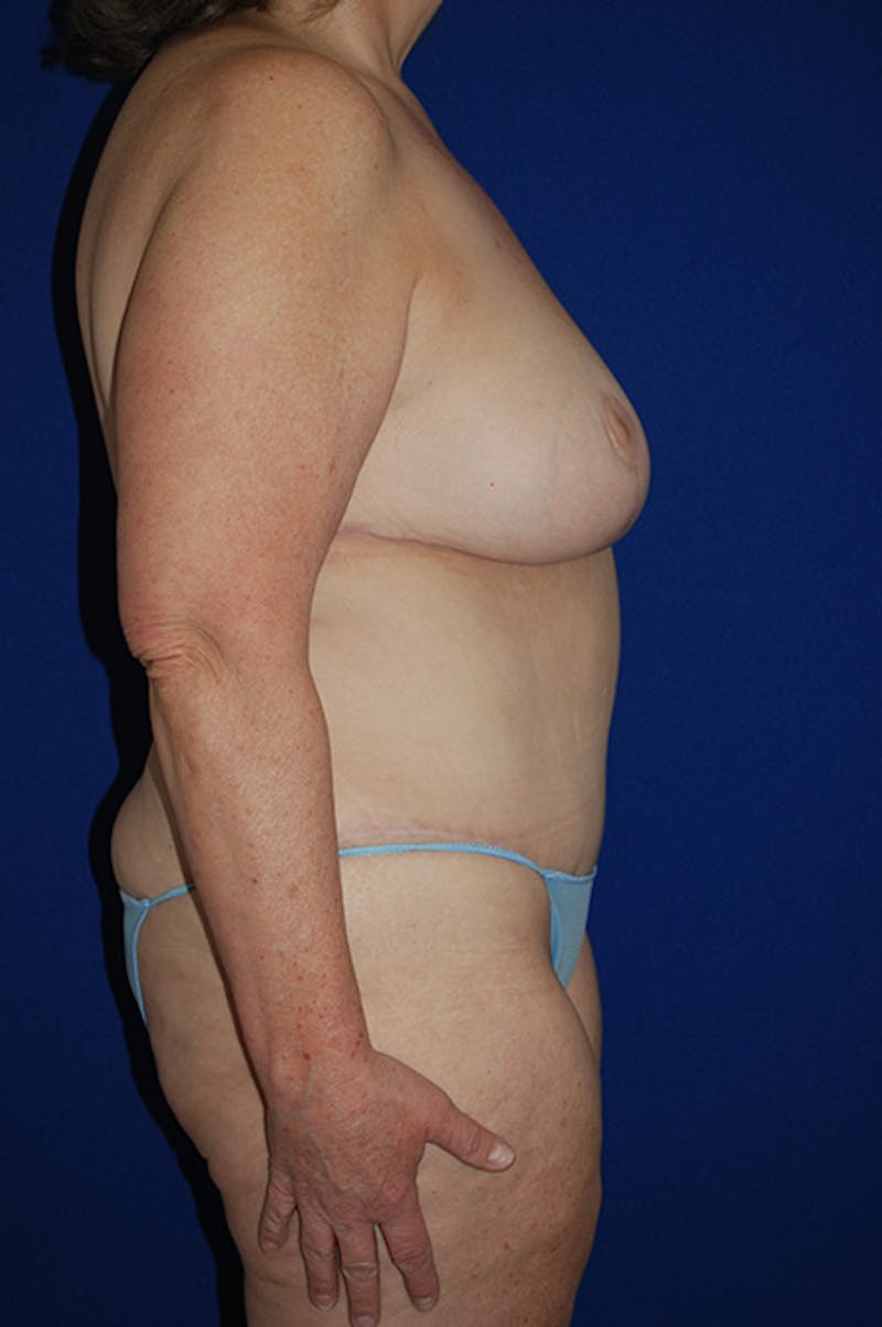 Extended Abdominoplasty Before & After Gallery - Patient 175185117 - Image 4