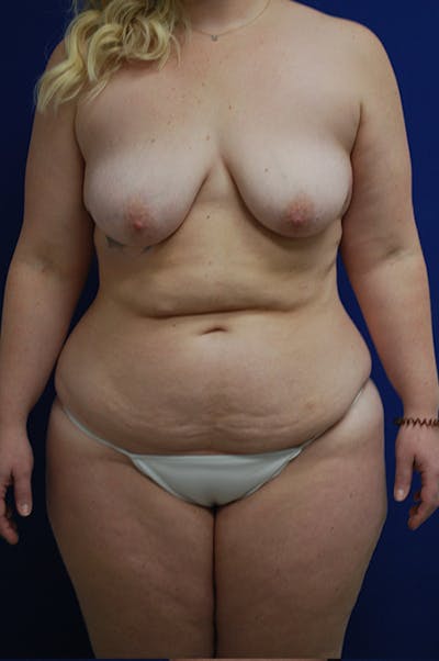 Mastopexy/Lift Before & After Gallery - Patient 175185746 - Image 1