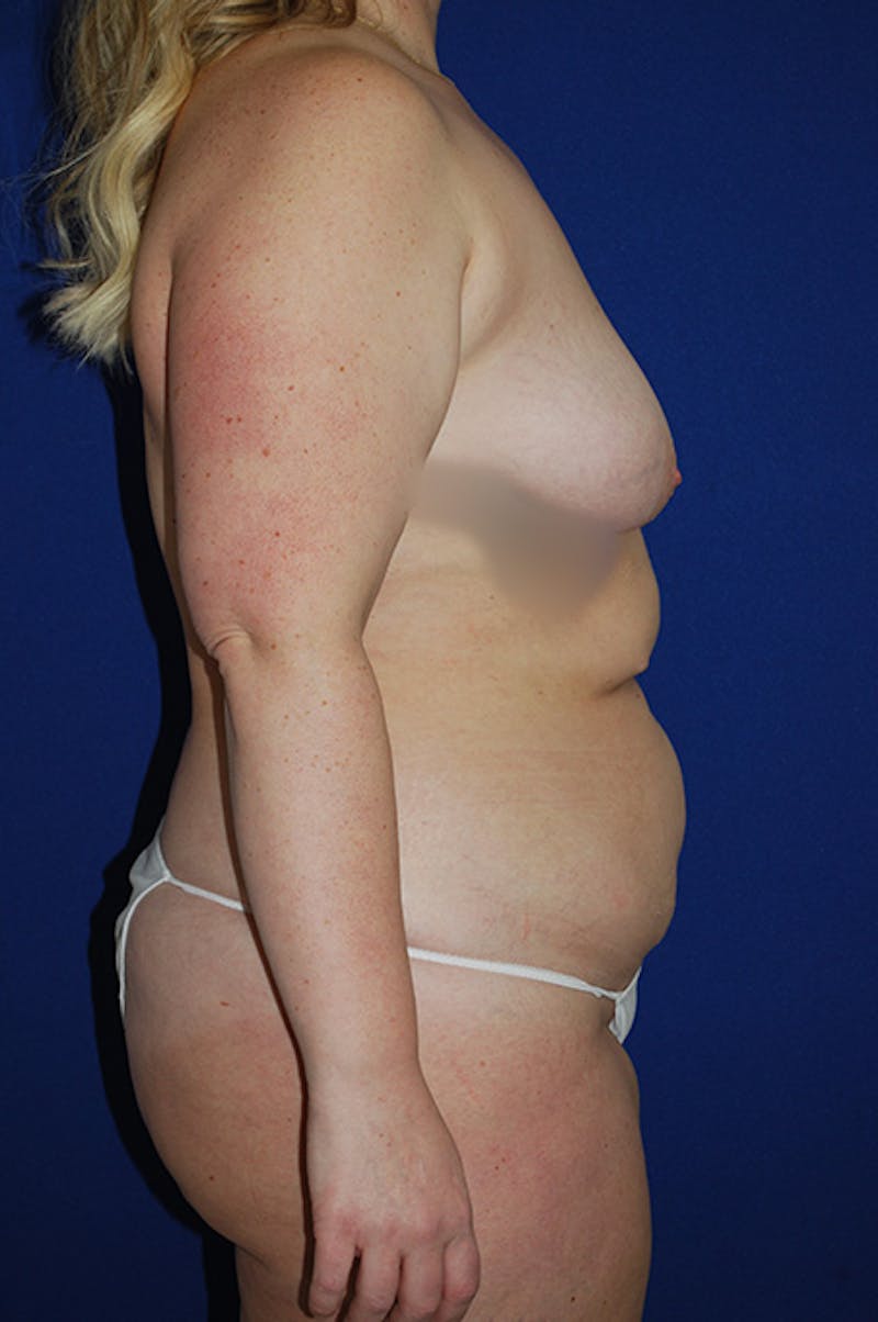 Extended Abdominoplasty Before & After Gallery - Patient 175185130 - Image 3