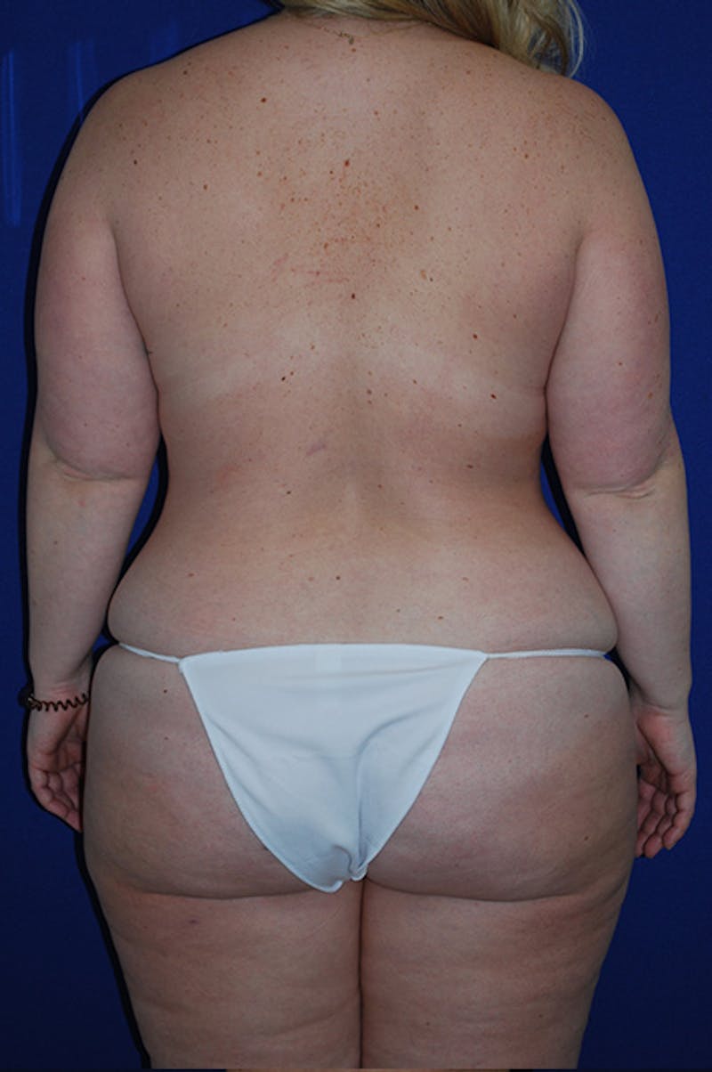 Extended Abdominoplasty Before & After Gallery - Patient 175185130 - Image 7