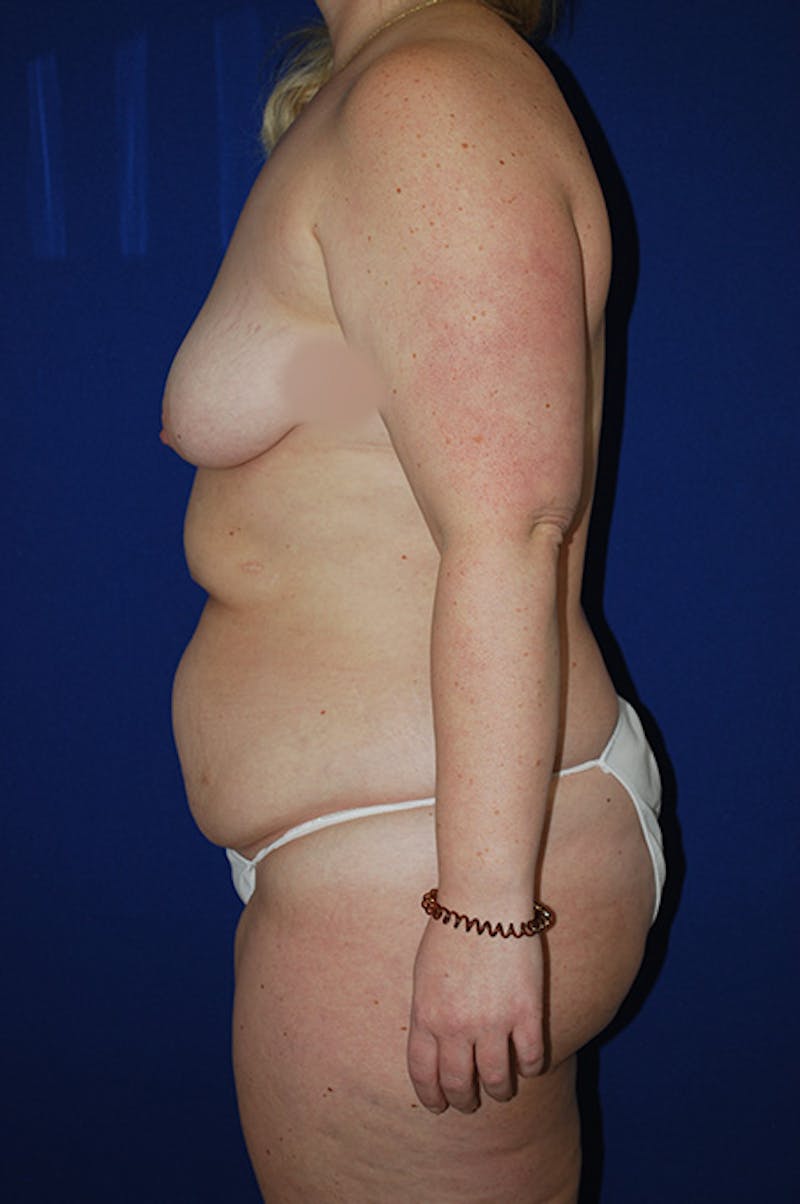 Extended Abdominoplasty Before & After Gallery - Patient 175185130 - Image 5