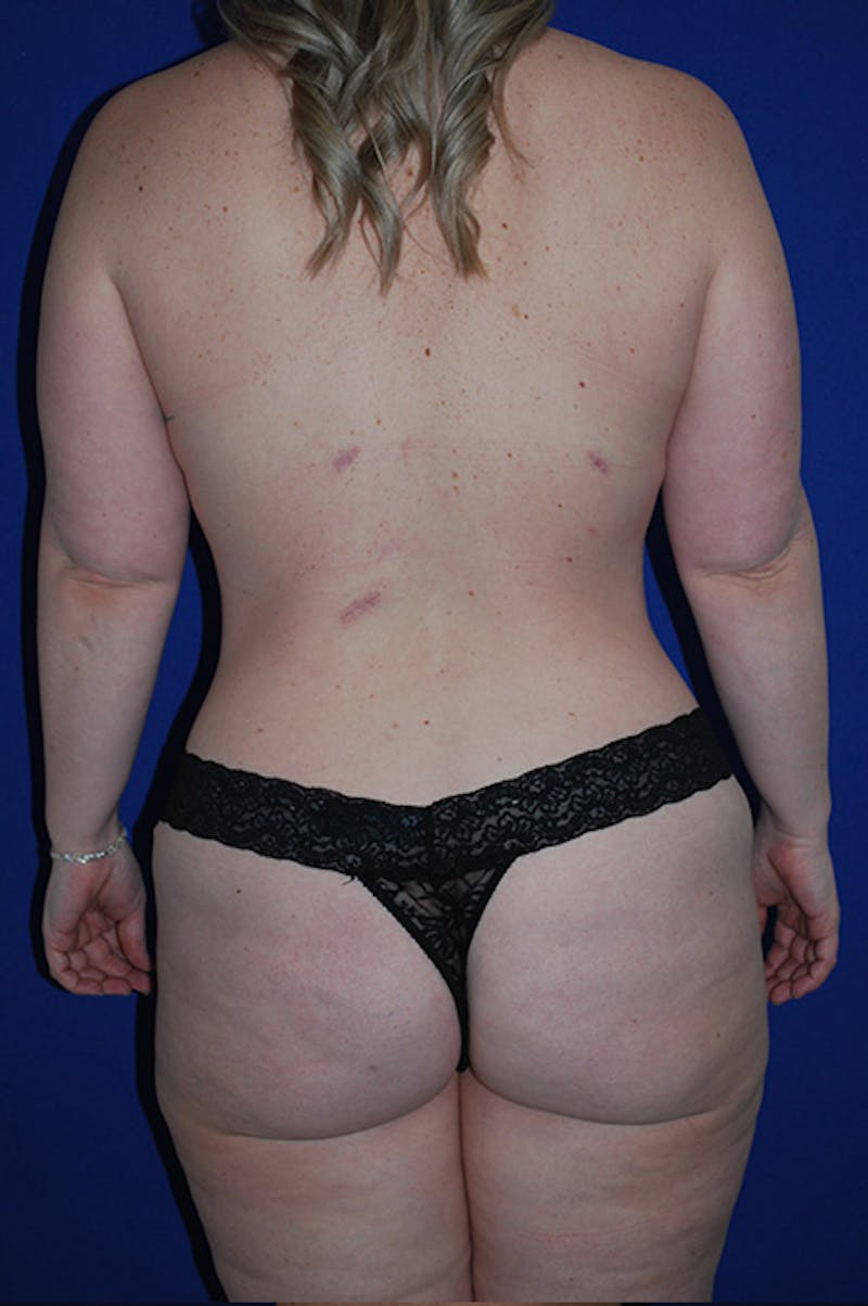 Extended Abdominoplasty Before & After Gallery - Patient 175185130 - Image 8