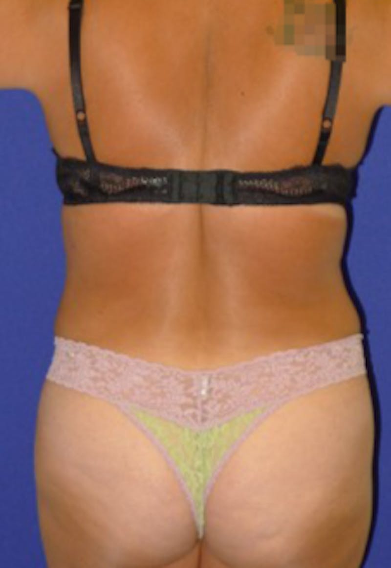 Mommy Makeover Before & After Gallery - Patient 175169112 - Image 8
