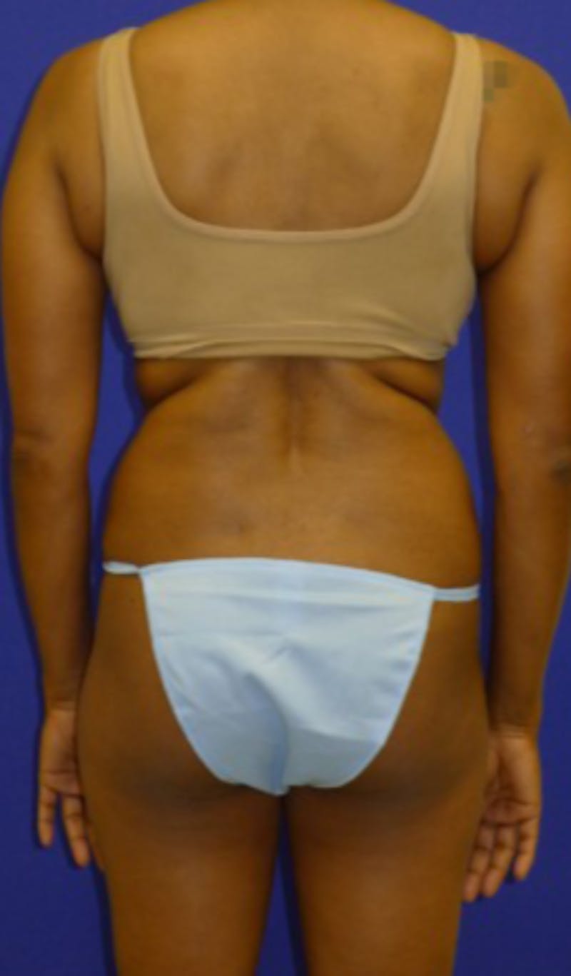 Mommy Makeover Before & After Gallery - Patient 175169133 - Image 5
