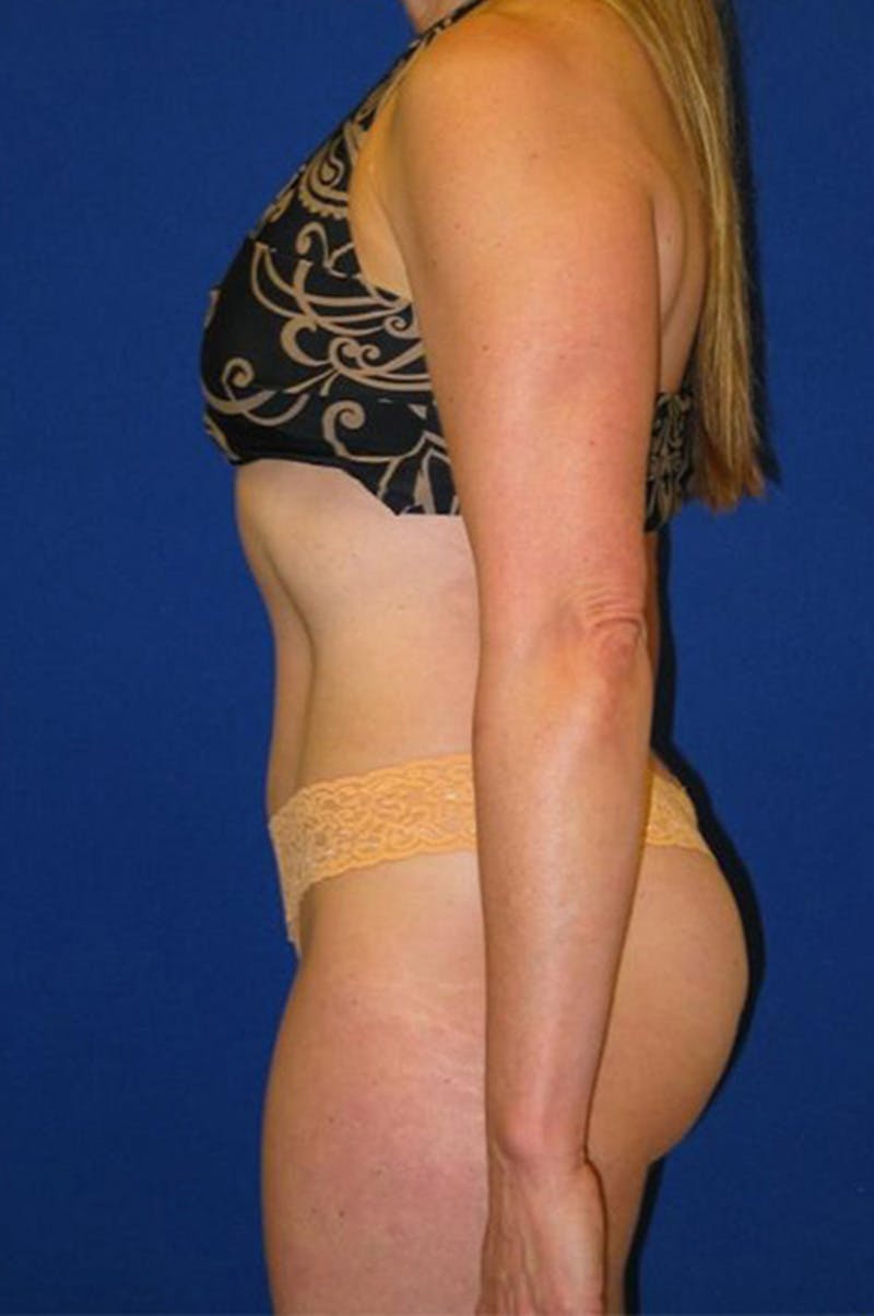 Liposuction Before & After Gallery - Patient 175169088 - Image 4