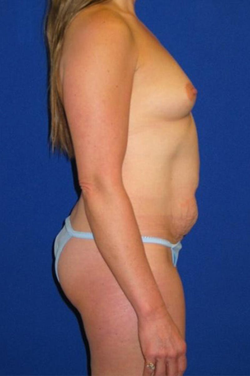 Liposuction Before & After Gallery - Patient 175169088 - Image 7