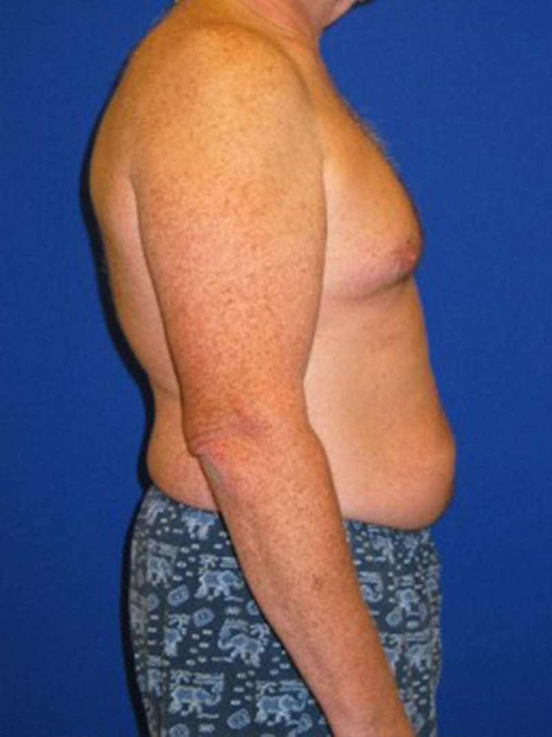 Liposuction Before & After Gallery - Patient 175169262 - Image 3