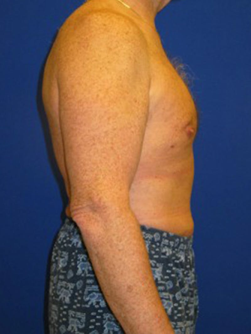 Liposuction Before & After Gallery - Patient 175169262 - Image 4