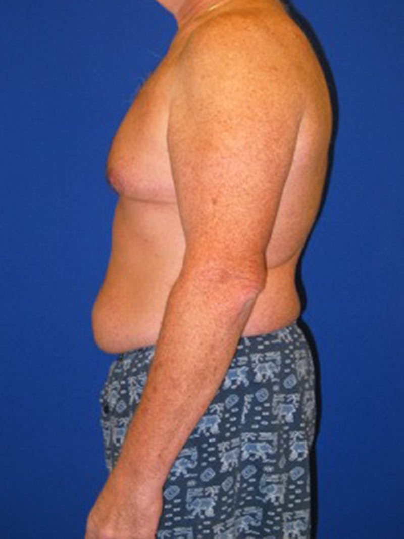 Liposuction Before & After Gallery - Patient 175169262 - Image 5