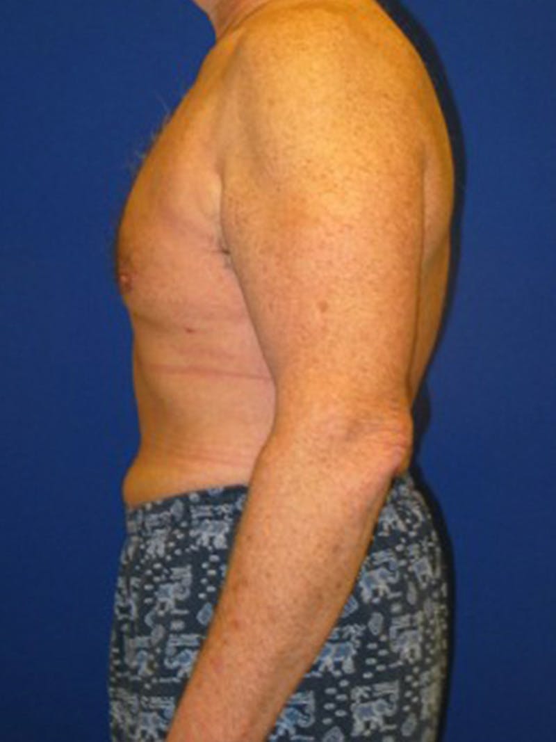 Liposuction Before & After Gallery - Patient 175169262 - Image 6