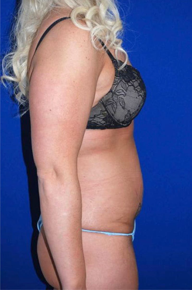 Extended Abdominoplasty Before & After Gallery - Patient 178915912 - Image 3