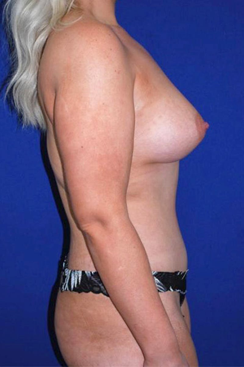 Extended Abdominoplasty Before & After Gallery - Patient 178915912 - Image 4