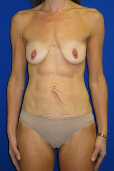 Mini Abdominoplasty Before & After Gallery - Patient 175168973 - Image 1